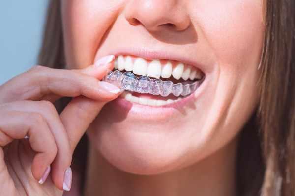 Invisalign London